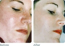 Roseaca 
Before & After photos using Glymed Plus products
