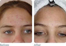 Acne 
Before & After Photos
