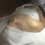 Teenage Acne Facial