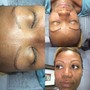 Brow Enhancement