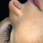 Microdermabrasion