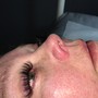 Microdermabrasion