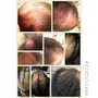 Scalp Treatment