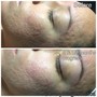 Chemical Peel