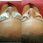 Back facial