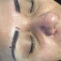 Scar Resurfacing Treatment