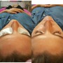 Oxygen Facial