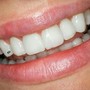 Professional Teeth Whitening Training