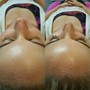 Back facial