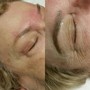 Microdermabrasion