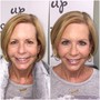 BOTOX GLOWTOX FACIAL