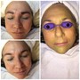 Dermaplaning Facial