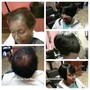 Scalp Treatment