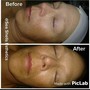 Oxygen facial