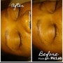 Oxygen facial