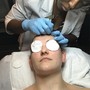 Microdermabrasion Crystal Facial Treamtent