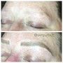 Microdermabrasion