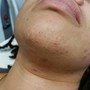 MicroNeedling