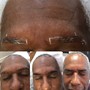 Hair restoration for edges or scalp