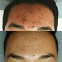 Microdermabrasion (Face)