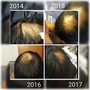 LED Scalp Therapy