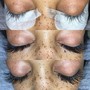 Dermaplaning