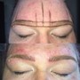 MicroNeedling