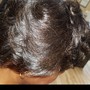 Scalp Treatment for Dandruff