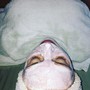 Microdermabrasion