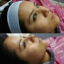 Microdermabrasion (Face)