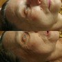 3 Chemical Peel Package