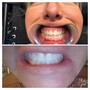 Laser Teeth Whitening