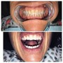 Laser Teeth Whitening