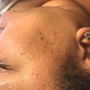 Tweezing ingrown hair's (beard)