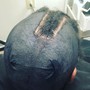 Scalp Treatment