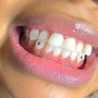 Teeth Whitening