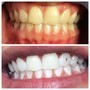 Teeth Whitening Follow Up