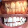 Teeth Whitening