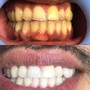 Teeth Whitening Follow Up