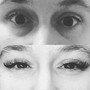 Eyelash Extension Removal