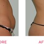 Skinny Lipo Shots