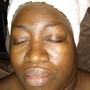 Acne Facial