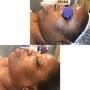 Facial Cupping