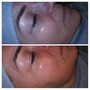 3 Chemical Peel Package