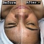 Hydra Facial