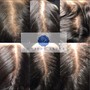 Medical Hair Restoration needling