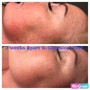 Microdermabrasion Crystal Facial Treamtent