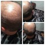 Scalp Treatment