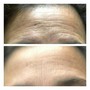 Dark Spot Removal