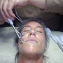 Microdermabrasion